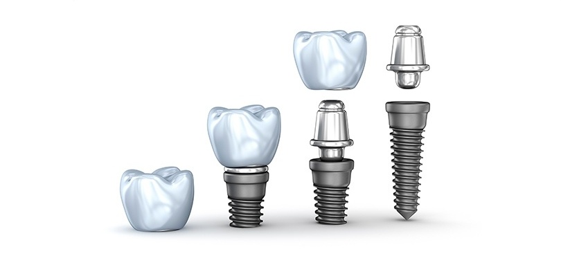 健康・医学 216 IMPLANTS Ultimate guide The Ultimate Guide To Dental Implants | Published